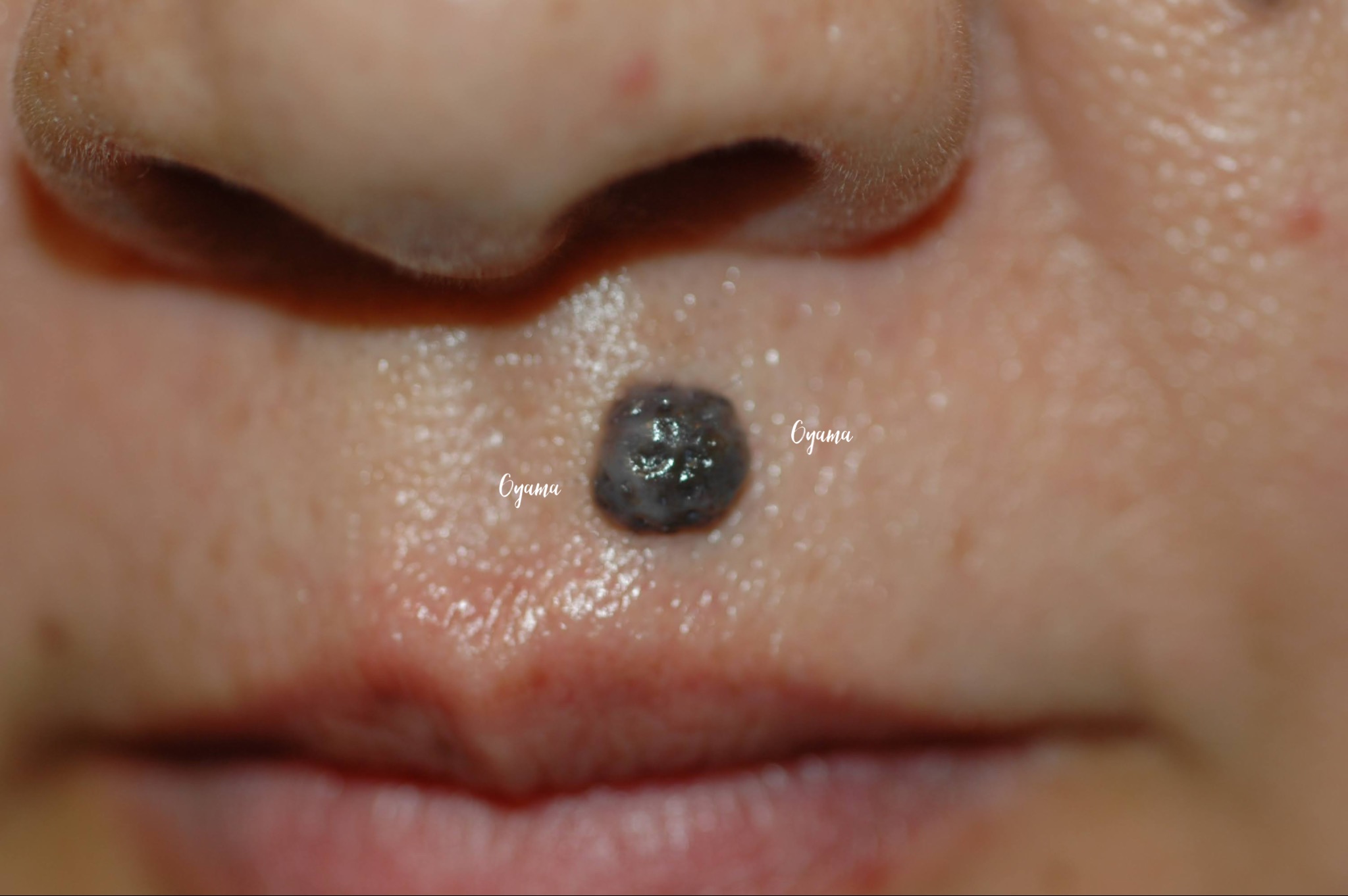 大きいほくろ除去