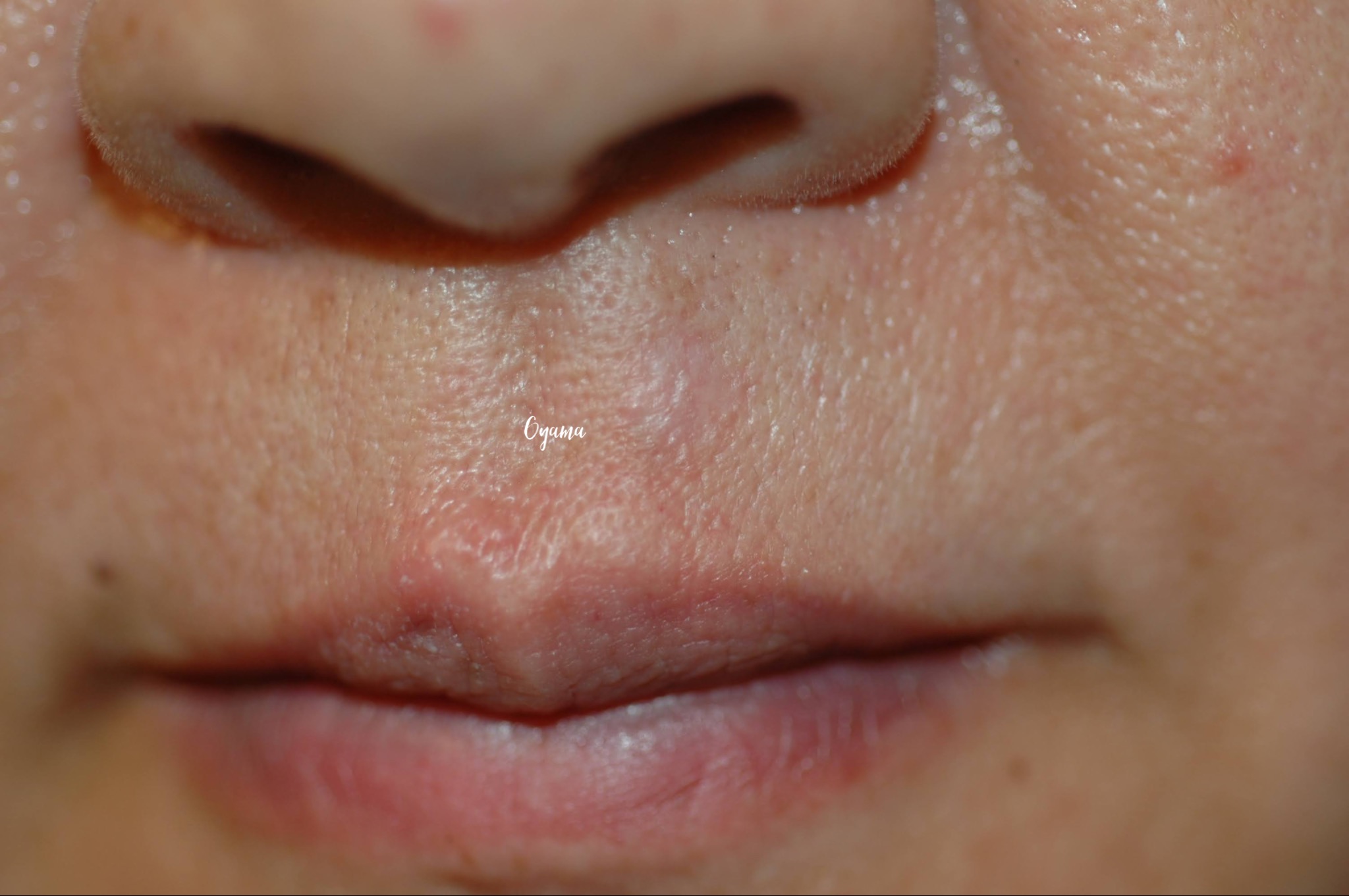 大きいほくろ除去