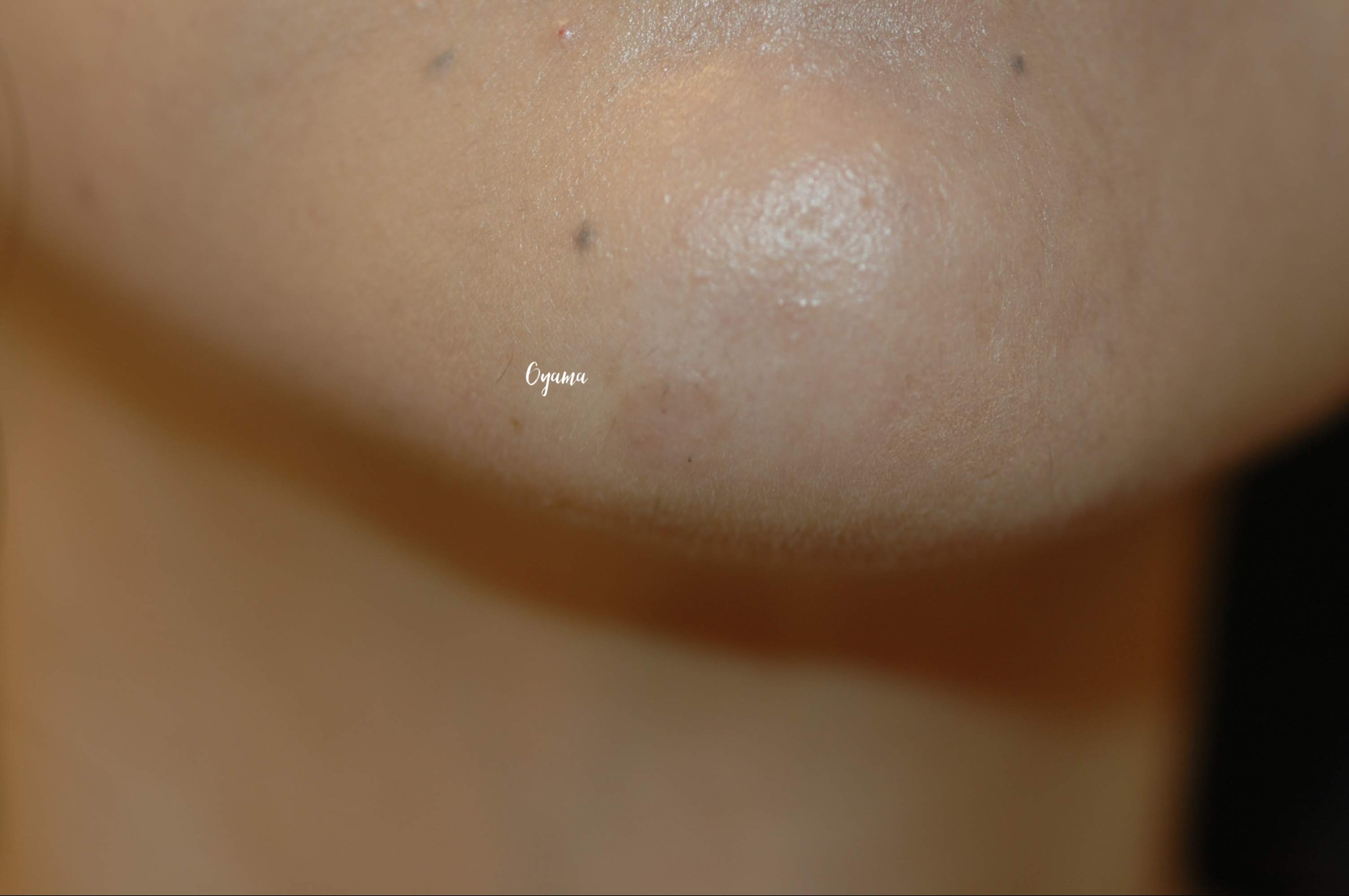 大きいほくろ除去