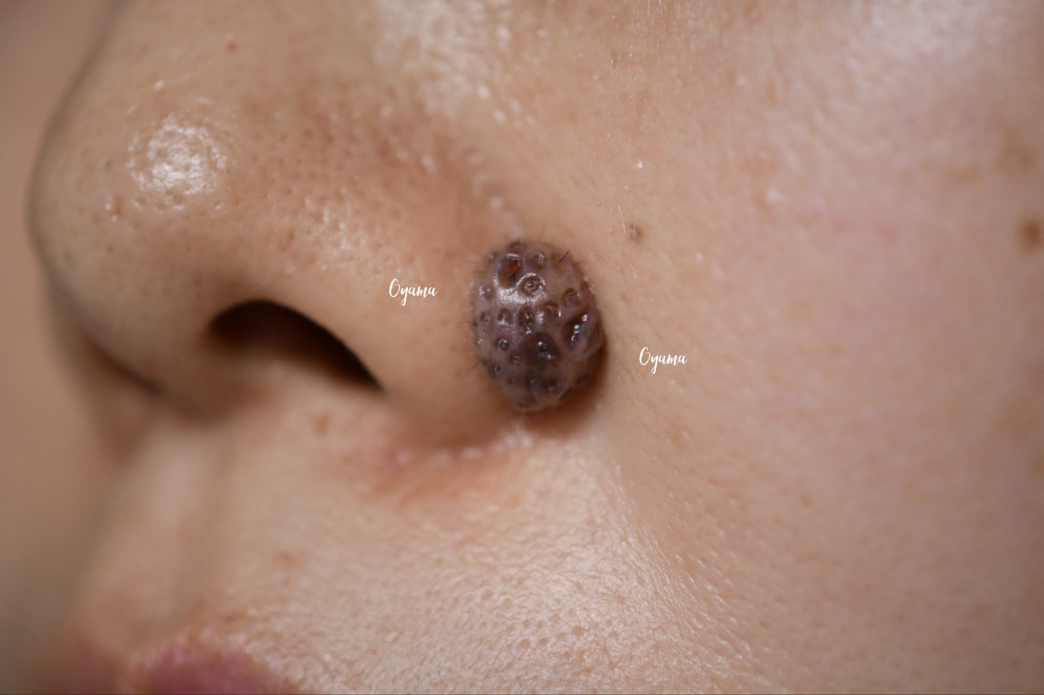 大きいほくろ除去