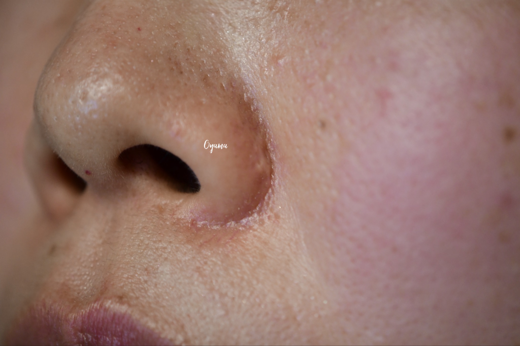 大きいほくろ除去