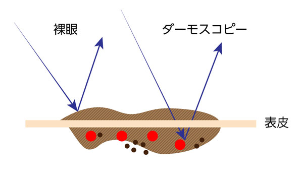 ダーモスコピー