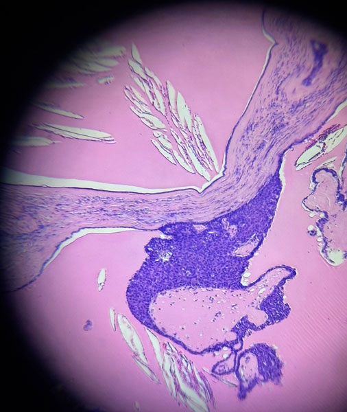 アポクリン汗嚢腫