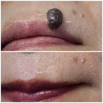 アレックスレーザー