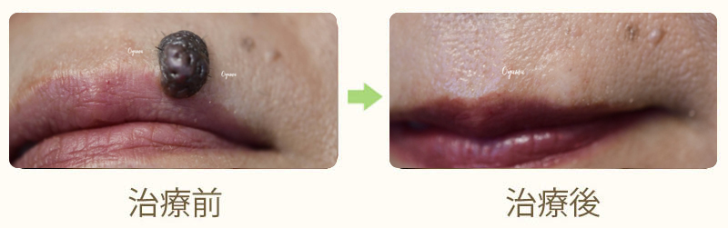 アレックスレーザー