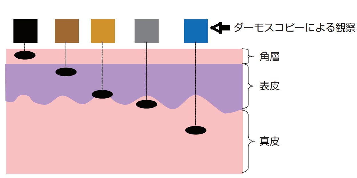 顔のホクロ