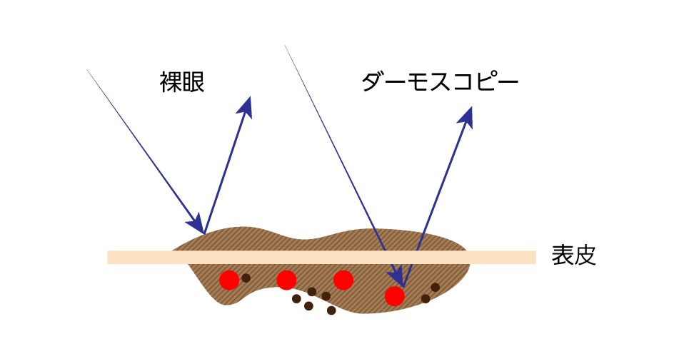 ここでホクロの診断に必要不可欠なダーモスコピーのお話しをします。