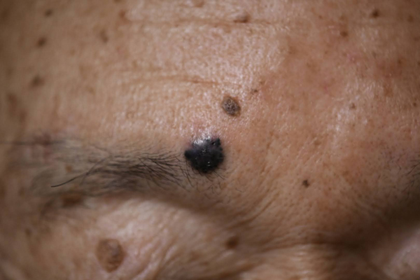 老人性イボの中に皮膚ガン