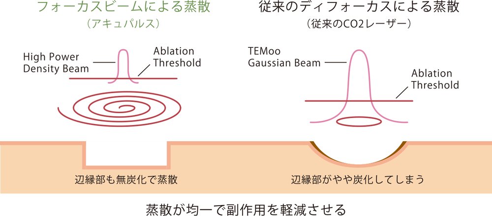 フォーカスビームによる蒸散(アキュパルス)と従来のディフォーカスによる蒸散の比較