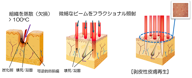 フラクショナルレーザーとは？